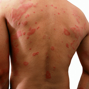 skin allergy
